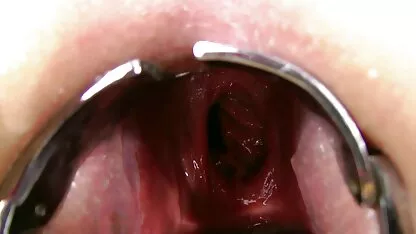 ప్రోలాప్స్ రష్యన్